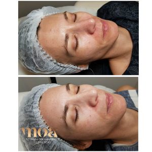 Microneedling Moa academy Microneedling Moa academy