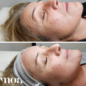 Microneedling Moa academy Microneedling Moa academy