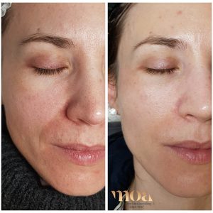 Microneedling Moa academy Microneedling Moa academy