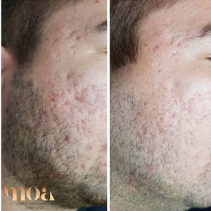 Microneedling Moa academy Microneedling Moa academy