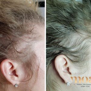 Microneedling Moa academy Microneedling Moa academy