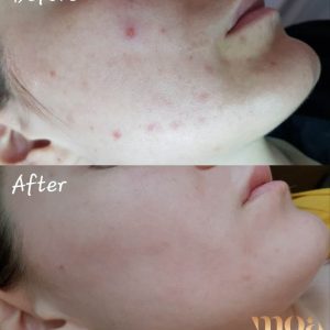 Microneedling Moa academy Microneedling Moa academy